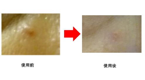 気になるイボ 角質粒などにアンミオイルのレビュー 50代 60代素敵に生活 キレイの情報発信ブログ